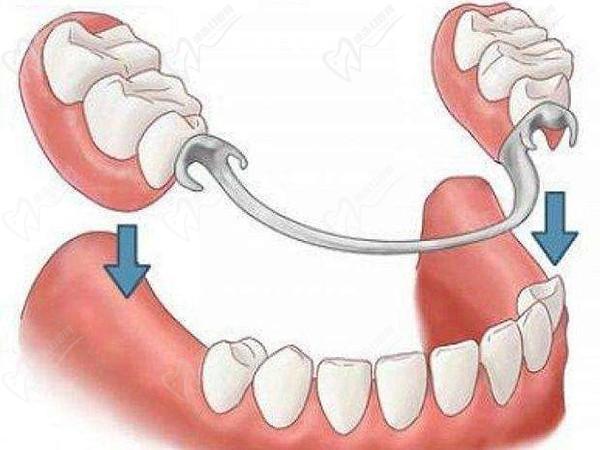 活动义齿和活动假牙是一种牙吗？问活动义齿有几种类型哪种更舒服？