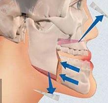 广州广大口腔正颌手术好吗？全国正畸正颌医生何锦泉技术太靠谱口碑贼好