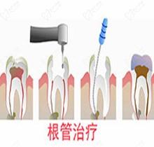 讲述热牙胶和冷牙胶区别，分析根管治疗用热冷牙胶哪个填充好？