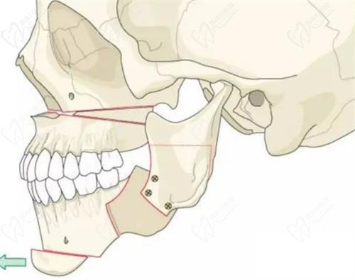 广州广大正颌手术怎么样？附正颌价格/医生推荐/网友评价