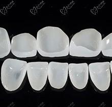 透露仿生复合瓷牙贴面一颗牙价格，在线分享耐用吗能保持几年