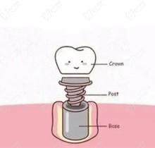 北京京谊口腔种植牙怎么样？医生种植牙技术水平高收费还便宜