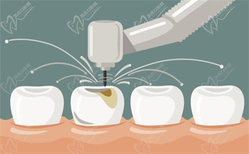 好烦牙拔了一直不补没事吧？听说拔牙后三年不补牙后果挺可怕