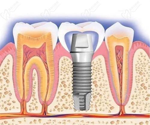 临汾麦特登口腔是做牙技术好的正规牙科，种植牙，矫正多少钱看这