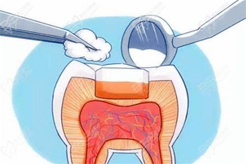 为什么有的人后悔补牙？医生为什么让做嵌体而不让我做牙冠？