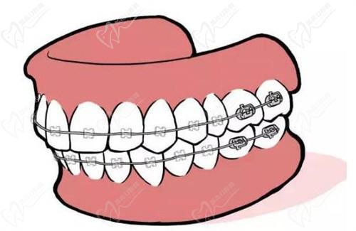 福州同福医口腔连锁正畸价格揭晓，金属自锁隐形矫正收费都不贵