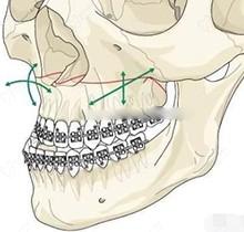 南京吴国平正颌手术怎么样？治疗骨性反颌|下巴后缩|偏颌好附费用