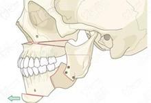 广州正颌手术要多少钱,2023年广州广大骨性正颌手术费为3.6w+