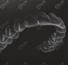 南京金铂利口腔矫正牙齿需要多少钱？隐适美隐形矫正39999元起