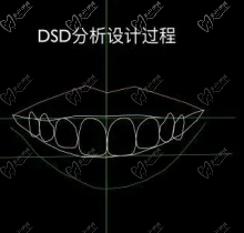 什么是dsd微笑美学设计？告诉我dsd微笑线是什么意思？
