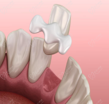 马里兰桥牙齿修复术为什么淘汰了？为什么大医院不让做马里兰桥