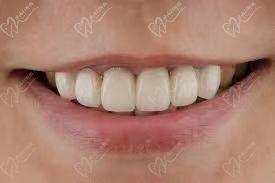 全瓷牙容易崩瓷吗？快来揭秘良心医生不建议做全瓷牙的真相