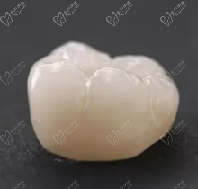 嵌体牙和全冠牙的区别是什么？补牙是做嵌体牙好还是全冠牙好