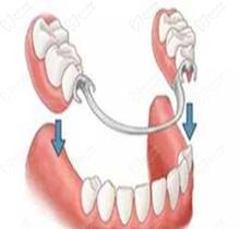 固定牙齿是怎么安的？固定假牙安装过程及注意事项全面解读