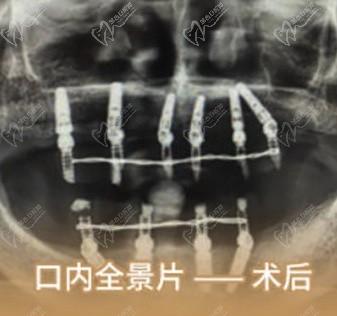 北京中诺口腔医院种牙靠谱吗？e+立得用数字化种植牙真的能当天种牙当天用