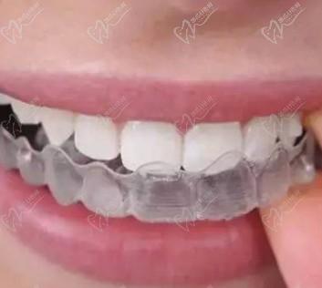 娄底爱牙邦口腔医院牙齿矫正价格表，时代天使隐形矫正仅15800元起