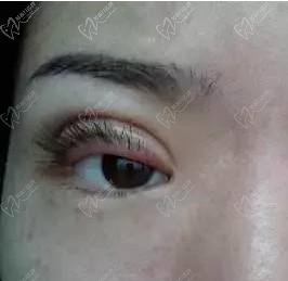 成镇模胎式修复双眼皮一绝，韩国高难度双眼皮修复都找他做