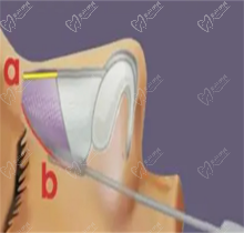 南京友谊吴国平做鼻子怎么样？很好-查询南京友谊吴国平口碑案例