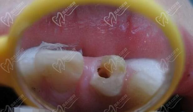 只剩牙根了还能补吗？镍铬烤瓷牙和钴铬烤瓷牙哪个好