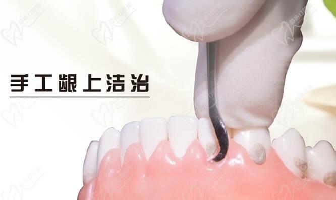 宜昌中汉口腔医院做龈下刮治怎么样？龈下刮治是按颗收费还是全口收费
