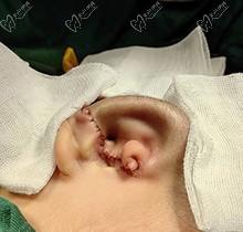安波耳再造是哪个医院？联合丽格第二医院-皮瓣法小切口生物支架耳再造好