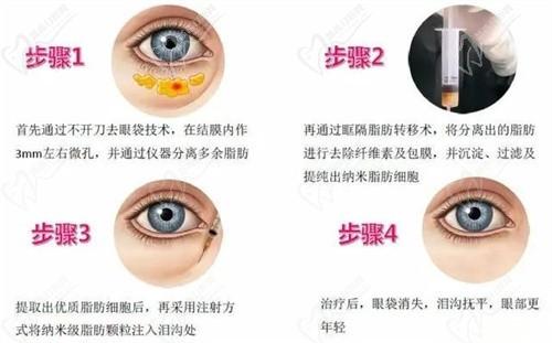 北京紫洁um无痕去眼袋6800元起,不开刀不留疤轻松恢复紧致眼周