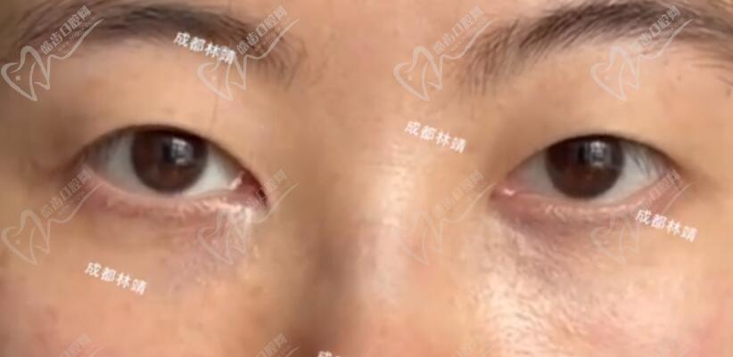 成都林靖修复后的眼睛自然吗？很自然且双眼皮修复.开眼角收费不贵有案例
