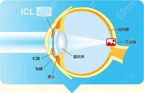 济南麦迪格眼科晶体植入价格29600起,定制近视方案视觉质量高