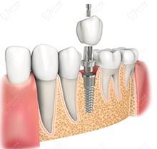 宁波艺星口腔种植牙怎么样？宁波艺星口腔医院种植牙价格表多少钱公布