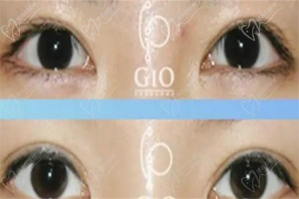 韩国gio整形外科病例