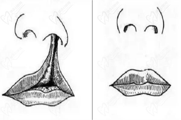 余文林唇裂修复费用2.8W起-看广州高尚余文林唇裂二期修复实际例