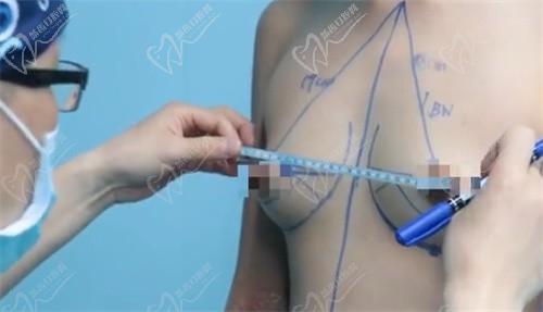 上海美莱汪灏隆胸双平面技术假体更稳定,在美莱工作数年案例多