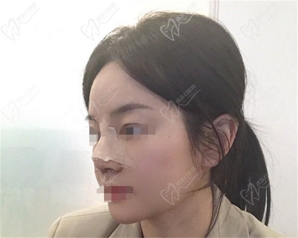 付俊俐做鼻子案例：别问她技术怎么样因为真的挺好的非常惊艳