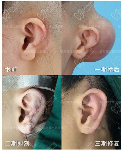 余文林做耳朵再造不是包装出来的,一期二期都亲自手术口碑好5.5w起