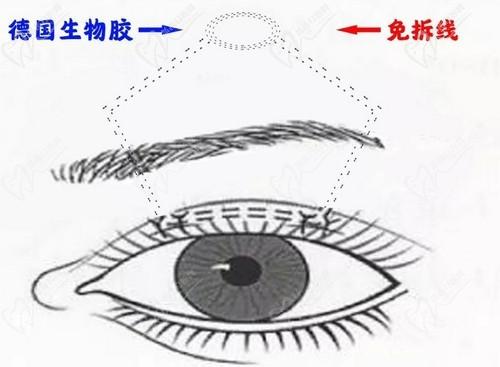 北京美和眼科医院于刚医生怎么样有谁知道吗？做上睑下垂很靠谱