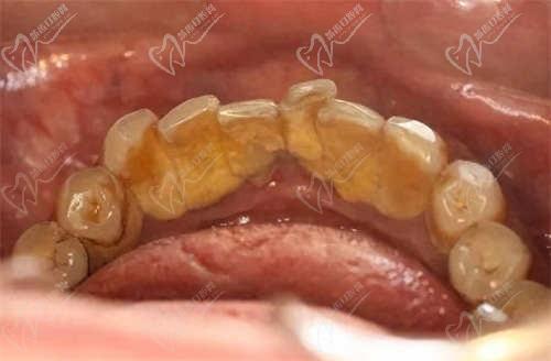 牙结石会导致口臭吗？来看看牙结石的几个等级