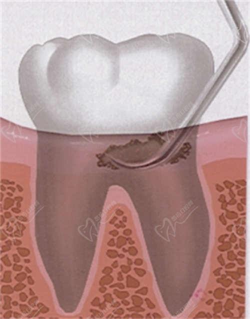 牙龈发黑是怎么回事？小心龈下牙结石！