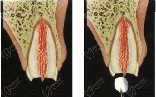 珠海六和口腔医院根管治疗怎么样?显微根管治疗效果好价格不贵