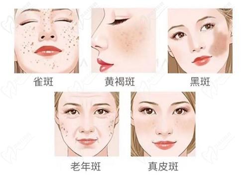 苏州美莱整形医院祛斑怎么效果好吗？祛斑价格透明公开附推荐医生