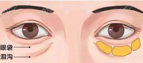张晋宝去眼袋在什么医院？张晋宝医生预约挂号在上海/广州健丽美诗沁