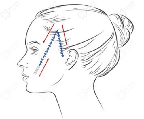 青岛壹美天成白华宝做拉皮口碑好，微拉美微创提升面部价格42800起