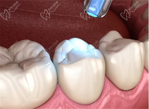   南充莱丁堡口腔门诊部汤鑫贇树脂补牙198元起，地址电话价格表全都有