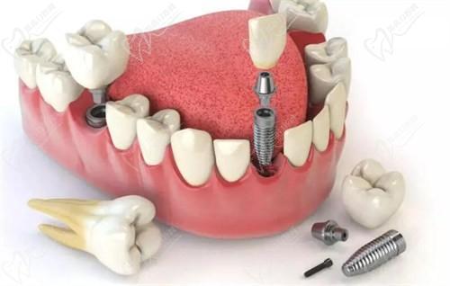 西安小白兔口腔韩国登腾种植牙3880起，选肖新医生技术靠谱