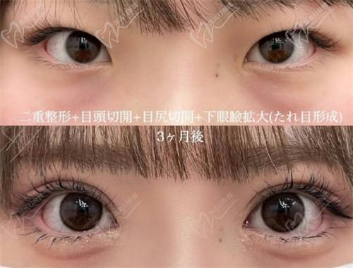 西安画美张莎莎做双眼皮技术好吗？真人实例双眼皮自然好看价格便宜
