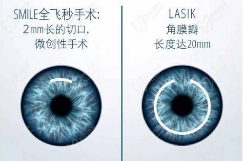 燕振国做近视手术怎么样？号称西北第一刀,在兰州华厦眼科医院预约