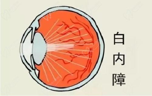 兰州普瑞眼科白内障手术做的好,刘永民医生5000元起亲自操刀,好评如潮！