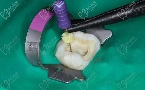 广州广大医院显微根管治疗费用1580元起，精准保住原生牙,医保可报销60%