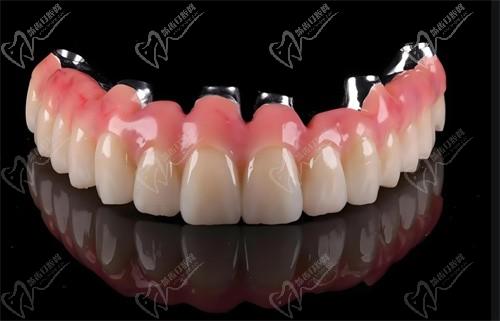 广州广大口腔张昌辉院长主刀德国威兰德全瓷牙冠2380元，美观耐用性价比高！