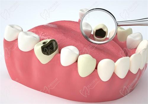 杭州雅莱口腔成人Z350树脂补牙单颗价格256元起，刘一璇医生补牙技术好