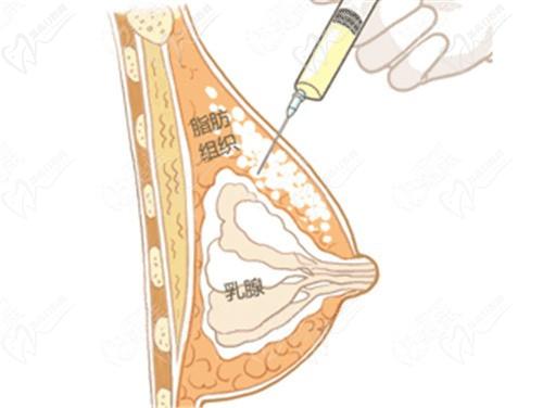 冯斌自体脂肪丰胸案例分享：超瘦女孩花38万打造自然美胸，效果惊艳！